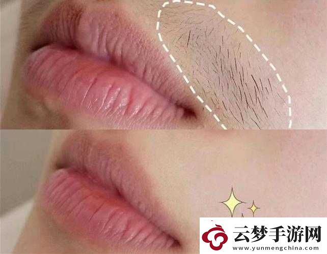 二十多岁唇毛明显到十八岁
